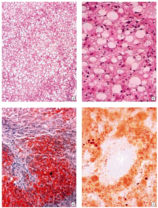 Жировая дистрофия печени рисунок микропрепарат
